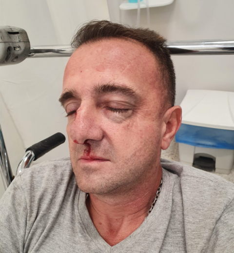 "רכב על האופנוע בפראות, צפרתי לו, אז הוא היכה אותי באגרופים וגרם לי לשברים בפנים" - חדשות בפתח תקווה