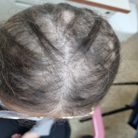 בת 12 סבלה מהתקרחות והודות לטיפול רב תחומי בשניידר קיבלה את שיערה בחזרה - בריאות בפתח תקווה